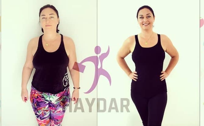 Johanna, before and after, front view